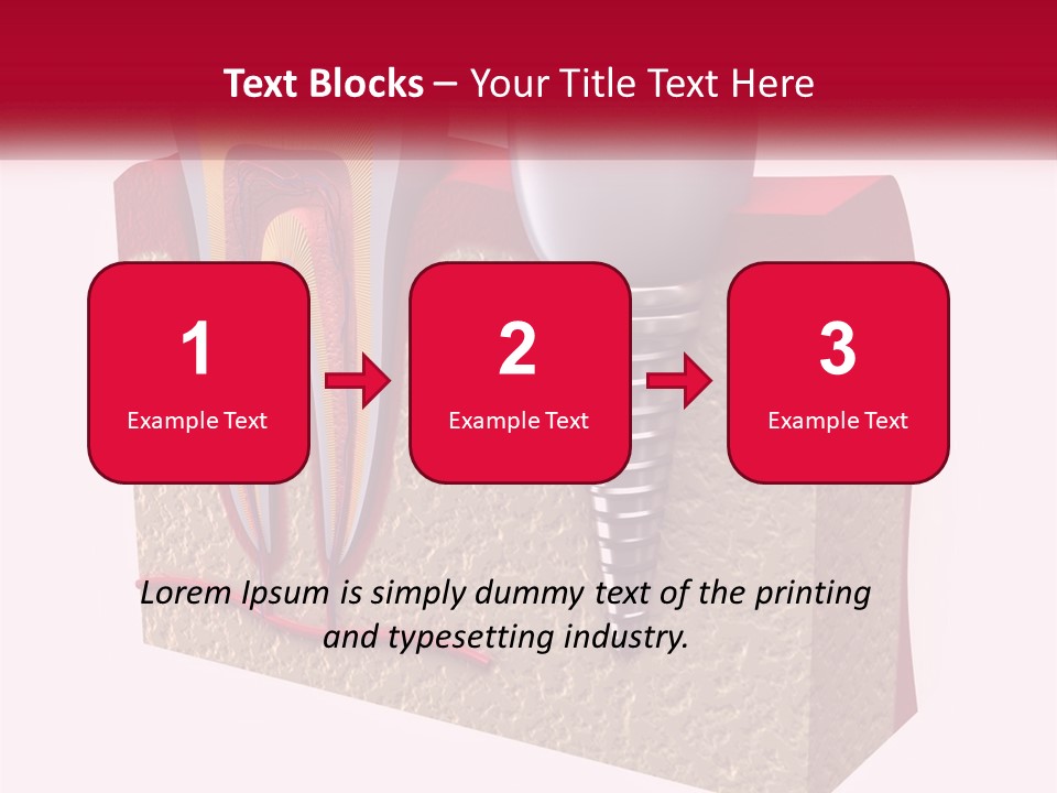 A Tooth With A Dental Implant On Top Of It PowerPoint Template