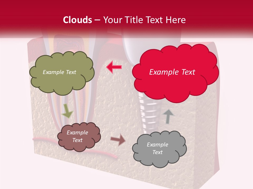 A Tooth With A Dental Implant On Top Of It PowerPoint Template