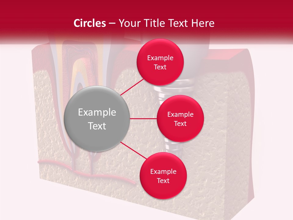 A Tooth With A Dental Implant On Top Of It PowerPoint Template