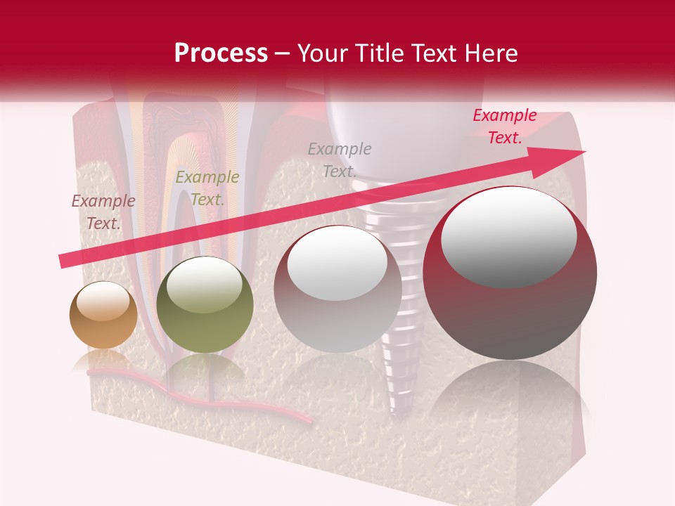 A Tooth With A Dental Implant On Top Of It PowerPoint Template