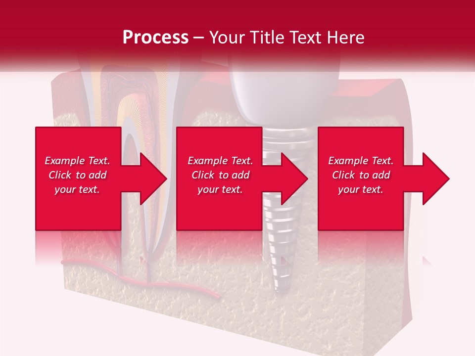 A Tooth With A Dental Implant On Top Of It PowerPoint Template