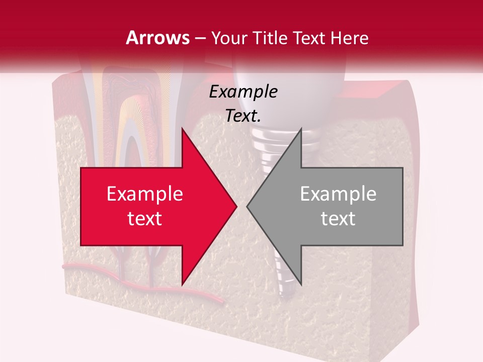 A Tooth With A Dental Implant On Top Of It PowerPoint Template