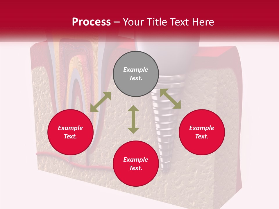 A Tooth With A Dental Implant On Top Of It PowerPoint Template