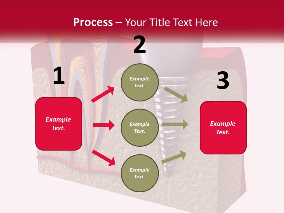A Tooth With A Dental Implant On Top Of It PowerPoint Template
