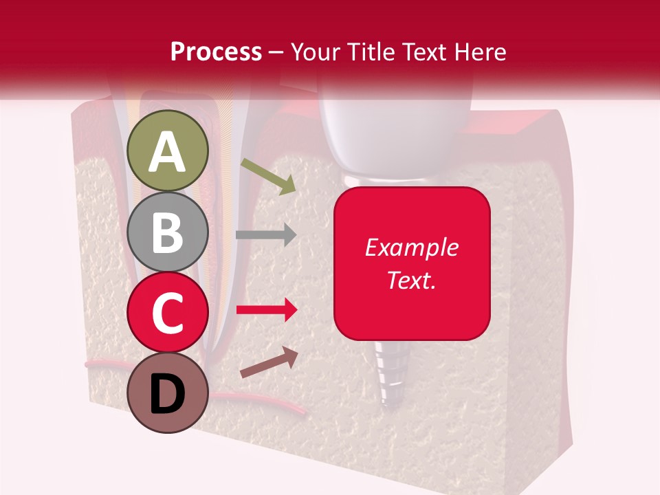 A Tooth With A Dental Implant On Top Of It PowerPoint Template