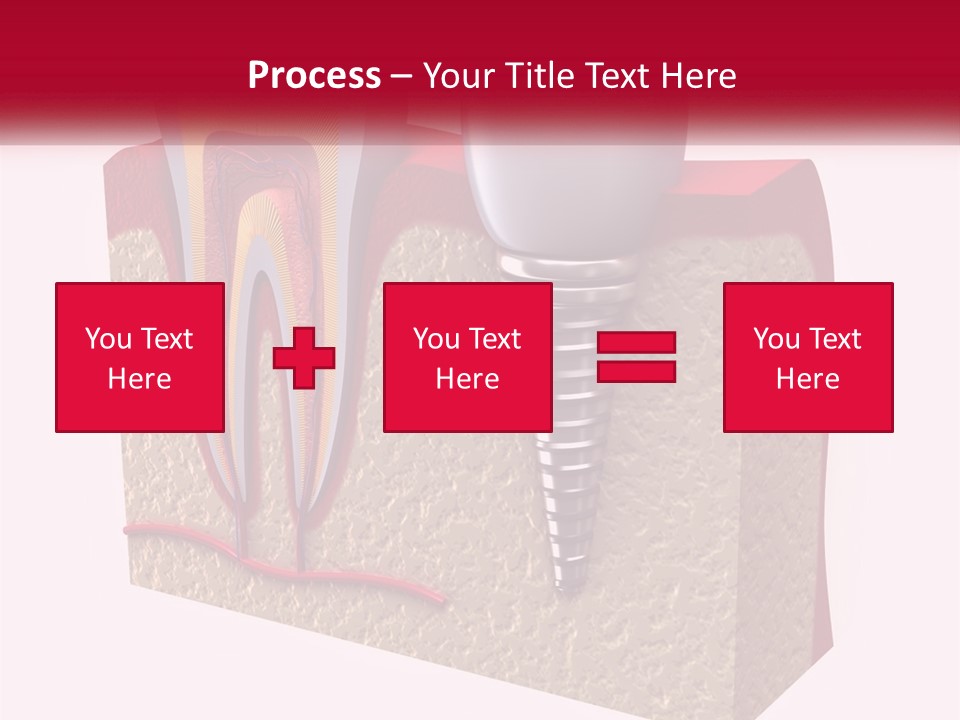 A Tooth With A Dental Implant On Top Of It PowerPoint Template