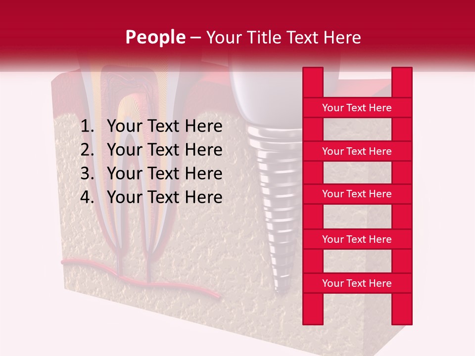 A Tooth With A Dental Implant On Top Of It PowerPoint Template