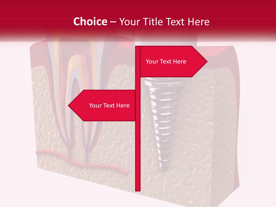A Tooth With A Dental Implant On Top Of It PowerPoint Template
