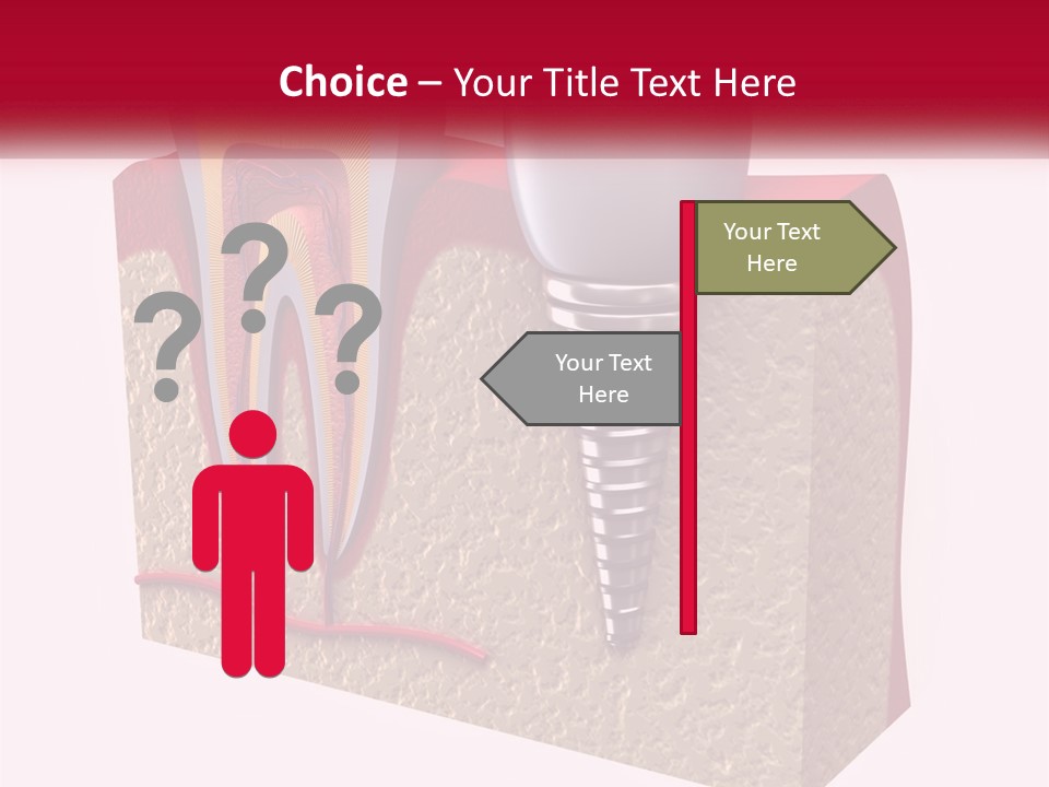 A Tooth With A Dental Implant On Top Of It PowerPoint Template