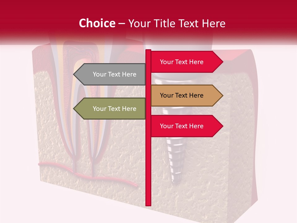 A Tooth With A Dental Implant On Top Of It PowerPoint Template
