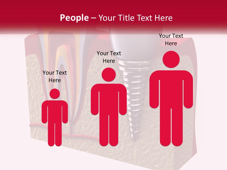 A Tooth With A Dental Implant On Top Of It PowerPoint Template