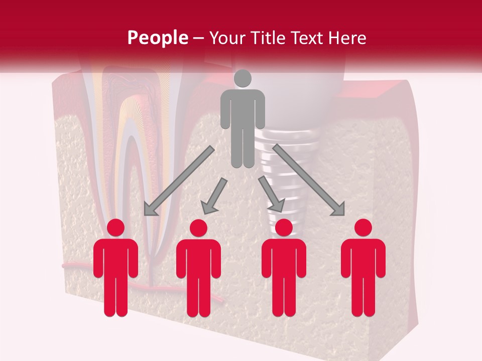 A Tooth With A Dental Implant On Top Of It PowerPoint Template