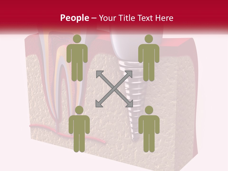 A Tooth With A Dental Implant On Top Of It PowerPoint Template