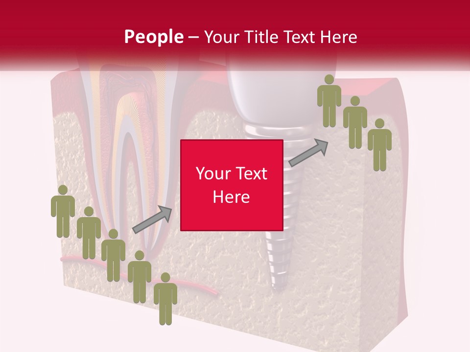 A Tooth With A Dental Implant On Top Of It PowerPoint Template