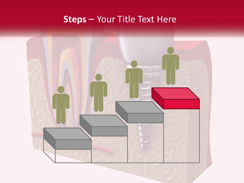 A Tooth With A Dental Implant On Top Of It PowerPoint Template