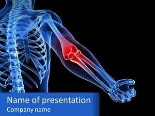 Elbow Pain PowerPoint Template