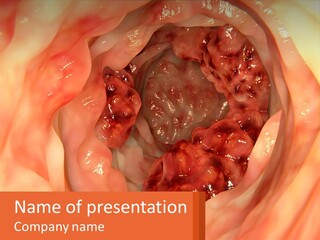 Ulcer PowerPoint Template