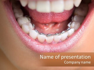 A Close Up Of A Person's Teeth With Braces PowerPoint Template