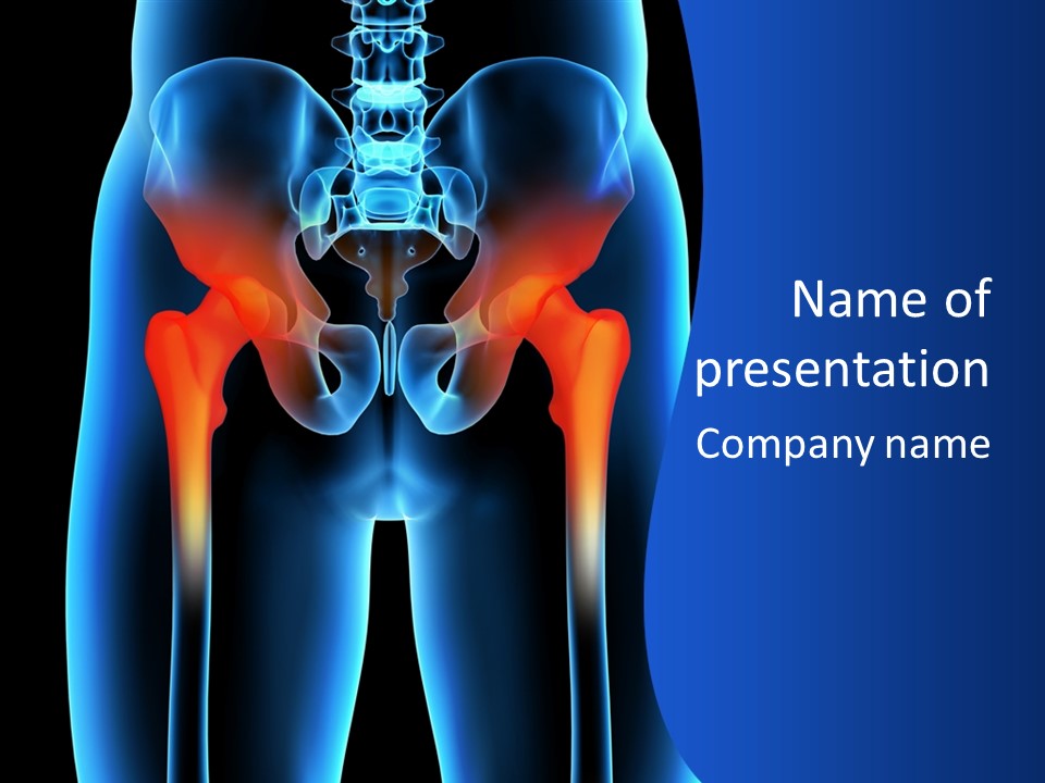 A Medical Powerpoint Presentation With A Highlighted Image Of A Man's Hip PowerPoint Template