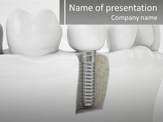 A Tooth With A Dental Implant On Top Of It PowerPoint Template