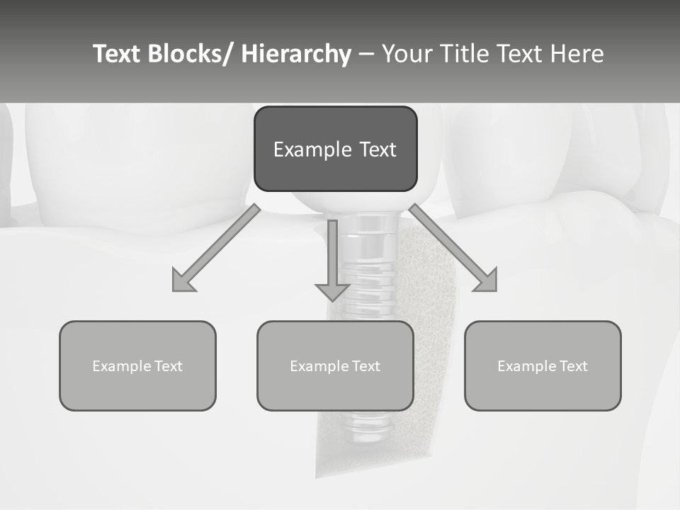 A Tooth With A Dental Implant On Top Of It PowerPoint Template