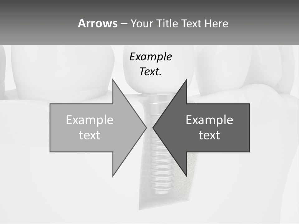 A Tooth With A Dental Implant On Top Of It PowerPoint Template