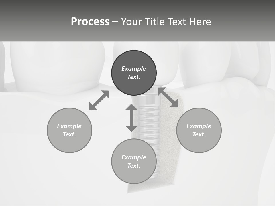 A Tooth With A Dental Implant On Top Of It PowerPoint Template