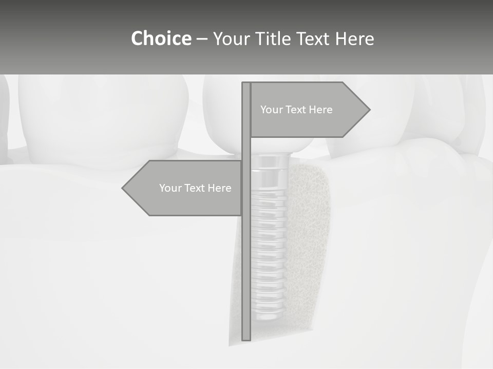 A Tooth With A Dental Implant On Top Of It PowerPoint Template