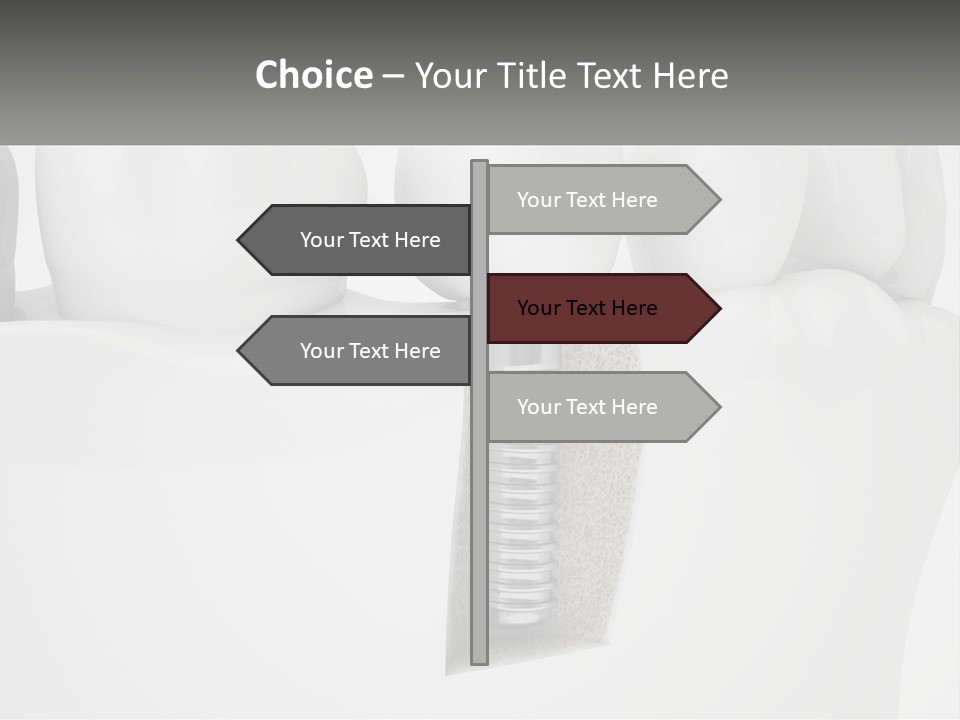 A Tooth With A Dental Implant On Top Of It PowerPoint Template