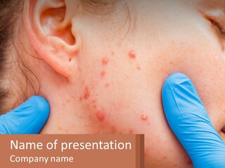 A Woman With Acne On Her Face And Blue Gloves PowerPoint Template