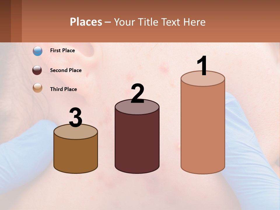 A Woman With Acne On Her Face And Blue Gloves PowerPoint Template