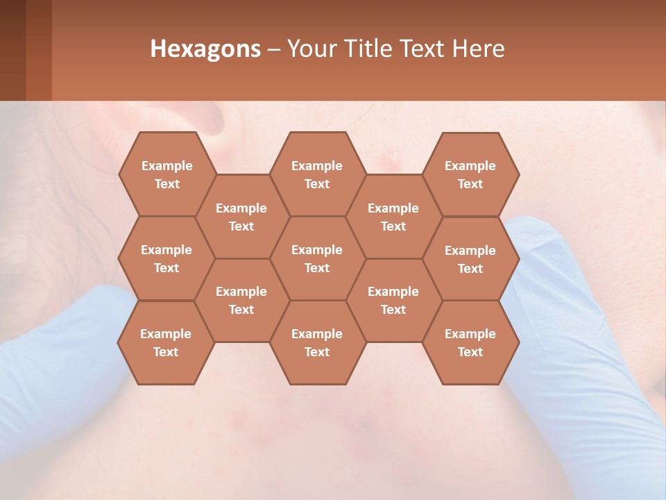 A Woman With Acne On Her Face And Blue Gloves PowerPoint Template