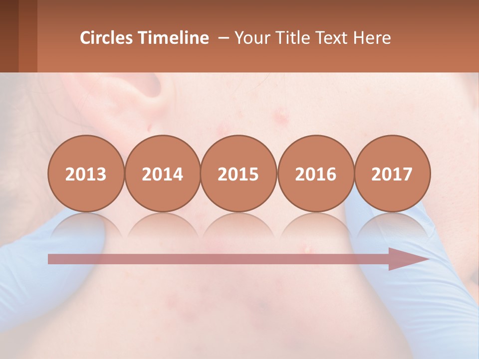 A Woman With Acne On Her Face And Blue Gloves PowerPoint Template