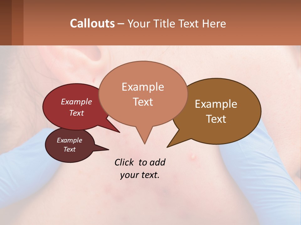 A Woman With Acne On Her Face And Blue Gloves PowerPoint Template