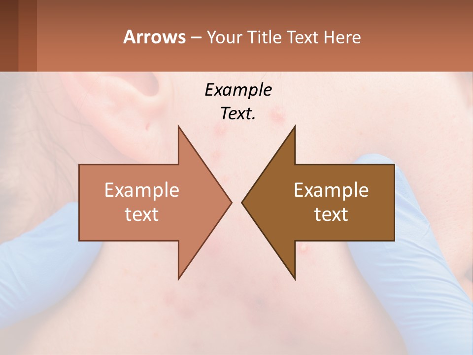 A Woman With Acne On Her Face And Blue Gloves PowerPoint Template