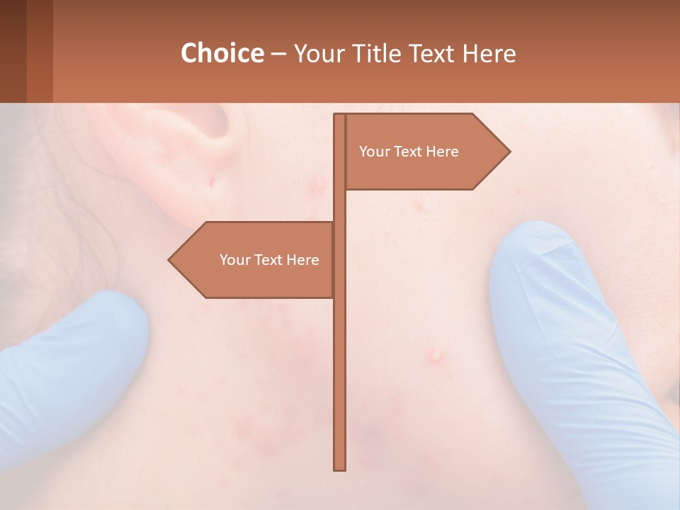 A Woman With Acne On Her Face And Blue Gloves PowerPoint Template