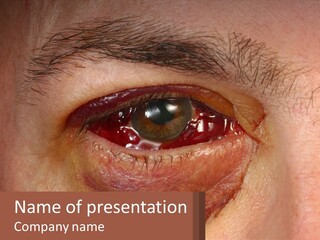 A Man With A Blood Stained Eye And A Name Of Presentation PowerPoint Template