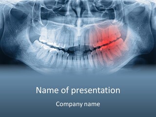 An X - Ray Of A Man's Teeth With A Red Spot In The PowerPoint Template