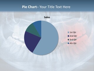 An X - Ray Of A Man's Teeth With A Red Spot In The PowerPoint Template