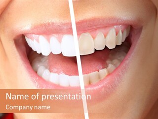 A Woman's Teeth Before And After Whitening PowerPoint Template