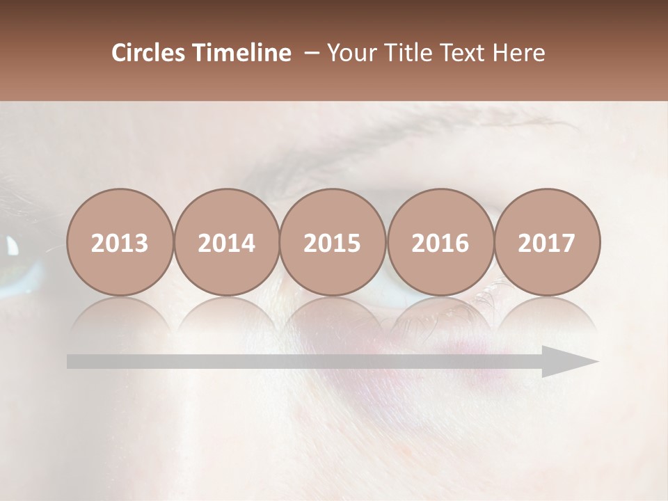 A Person With A Bruised Eye Has A Name Of Presentation PowerPoint Template