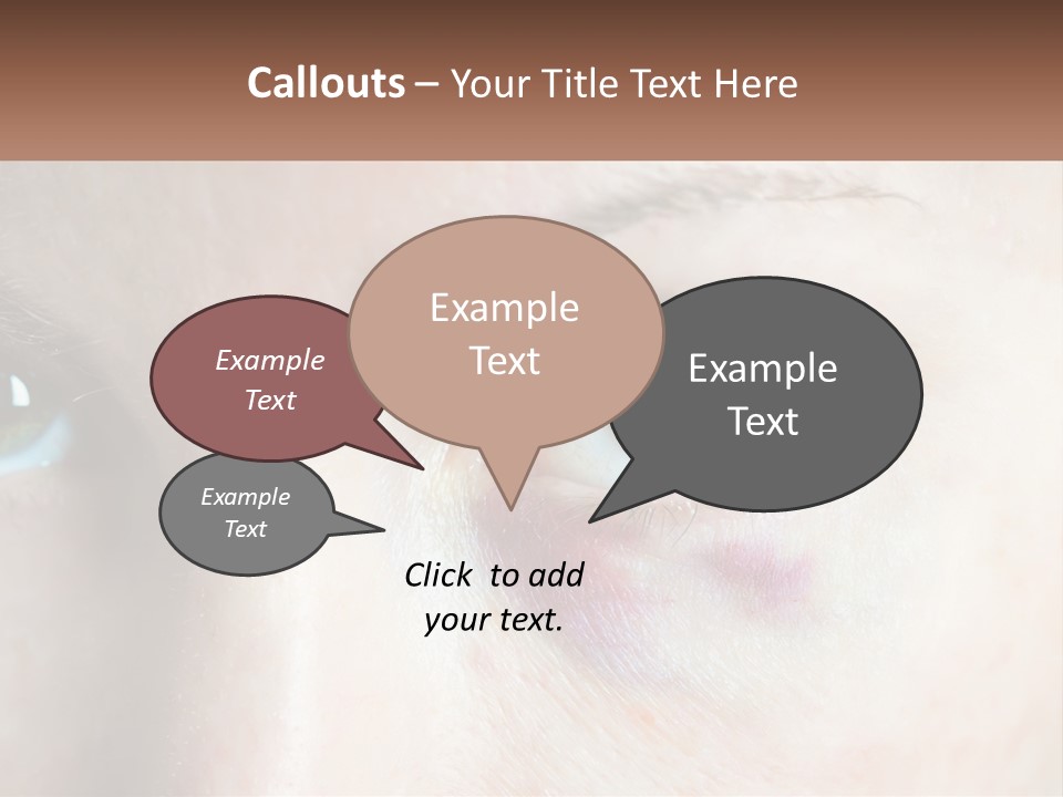 A Person With A Bruised Eye Has A Name Of Presentation PowerPoint Template