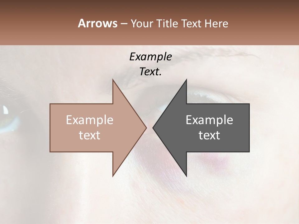 A Person With A Bruised Eye Has A Name Of Presentation PowerPoint Template