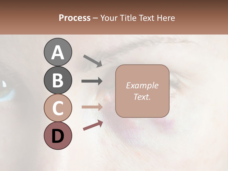A Person With A Bruised Eye Has A Name Of Presentation PowerPoint Template