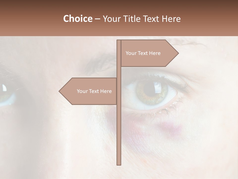 A Person With A Bruised Eye Has A Name Of Presentation PowerPoint Template