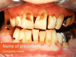 A Close Up Of A Person's Teeth With Gums PowerPoint Template