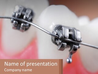 A Tooth With Braces On It Powerpoint Template PowerPoint Template