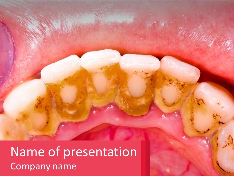 A Close Up Of A Tooth With Molds On It PowerPoint Template