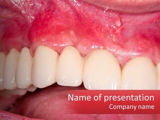 A Close Up Of A Tooth With A Plaque On It PowerPoint Template