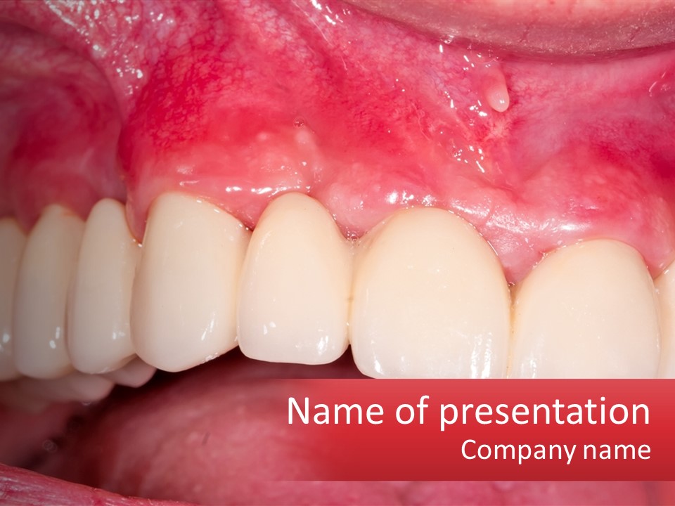 A Close Up Of A Tooth With A Plaque On It PowerPoint Template